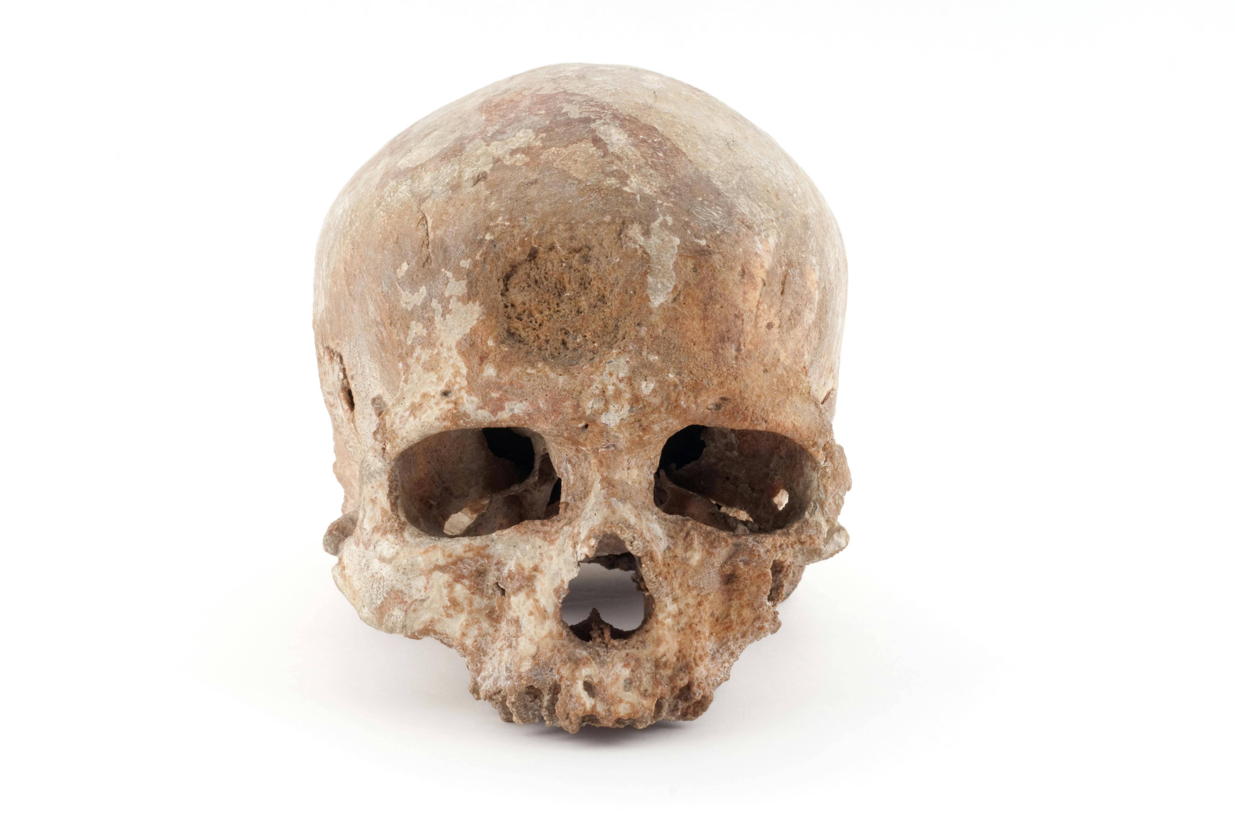 一块风化的人类头骨，有明显的磨损和缺牙，背景为纯白色。
